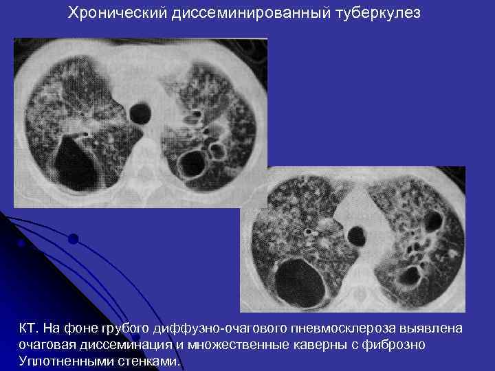  Хронический диссеминированный туберкулез КТ. На фоне грубого диффузно-очагового пневмосклероза выявлена очаговая диссеминация и