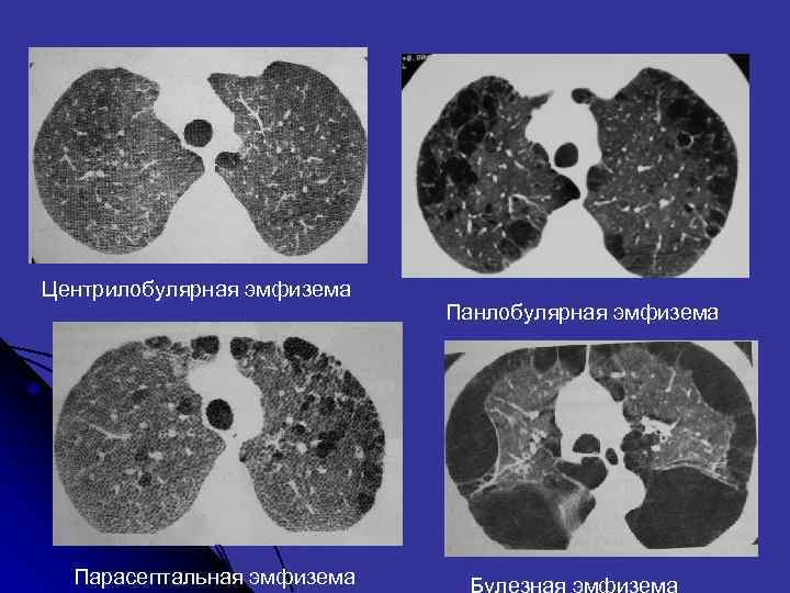 Центрилобулярная эмфизема Панлобулярная эмфизема Парасептальная эмфизема Булезная эмфизема 