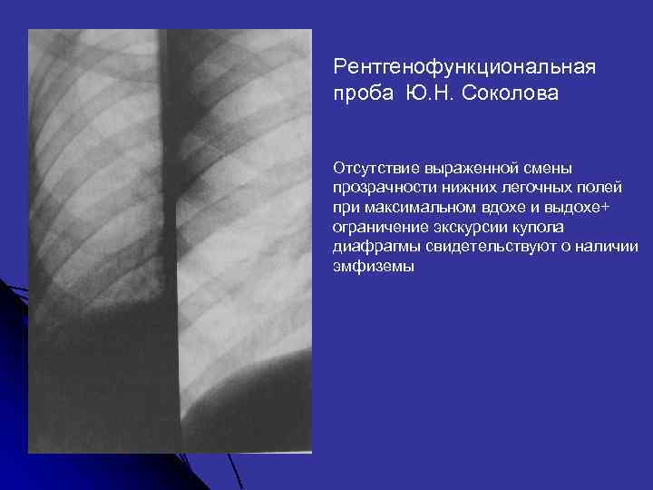 Рентгенофункциональная проба Ю. Н. Соколова Отсутствие выраженной смены прозрачности нижних легочных полей при максимальном