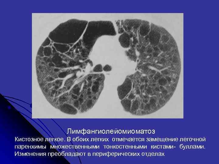  Лимфангиолейомиоматоз Кистозное легкое. В обоих легких отмечается замещение легочной паренхимы множественными тонкостенными кистами-