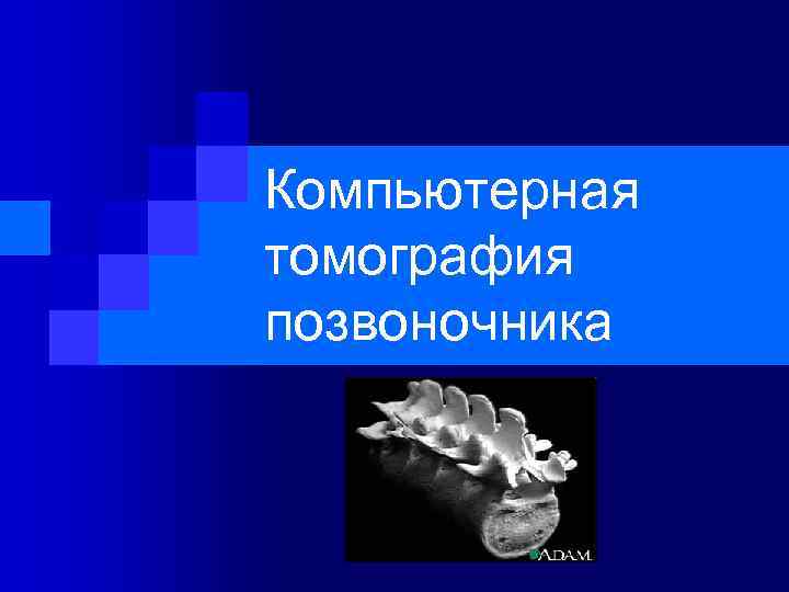Компьютерная томография позвоночника 