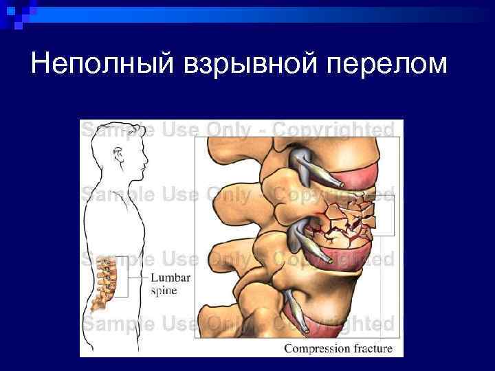 Неполный взрывной перелом 