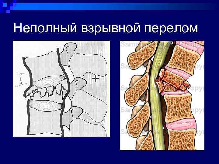 Перелом позвоночника рисунок