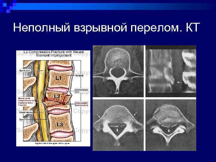 Неполный взрывной перелом. КТ 