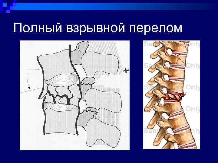 Компрессионно оскольчатый перелом