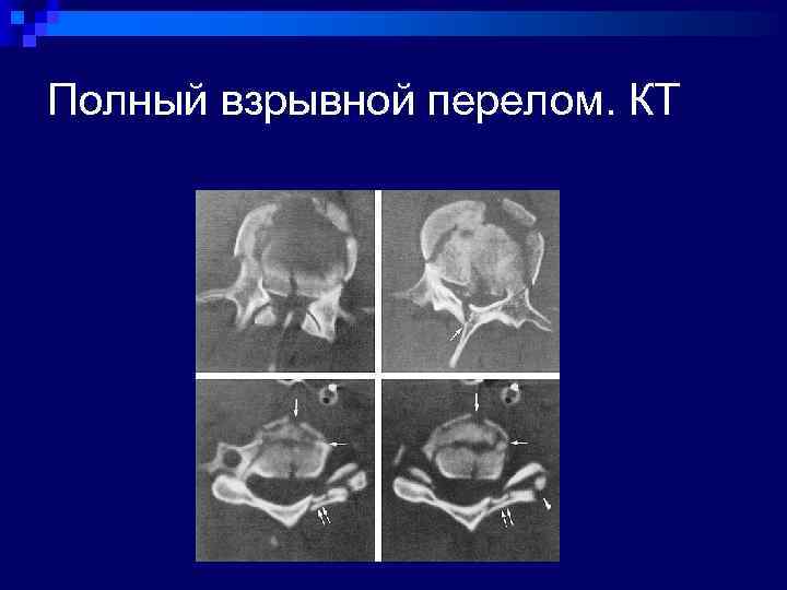 Полный взрывной перелом. КТ 