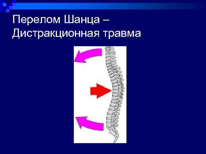 Перелом Шанца – Дистракционная травма 