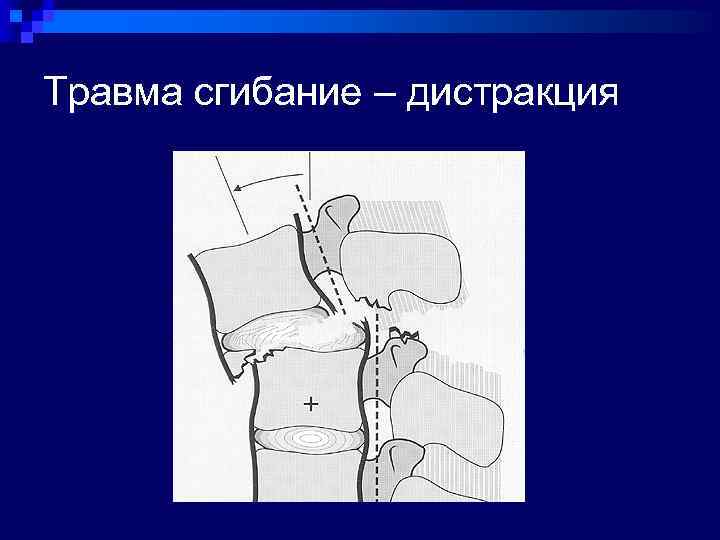 Травма сгибание – дистракция 