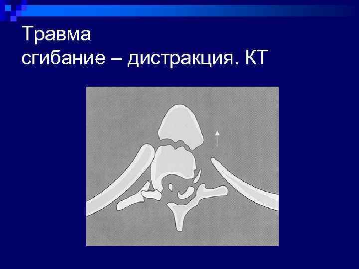 Травма сгибание – дистракция. КТ 