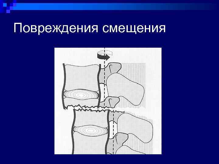 Повреждения смещения 