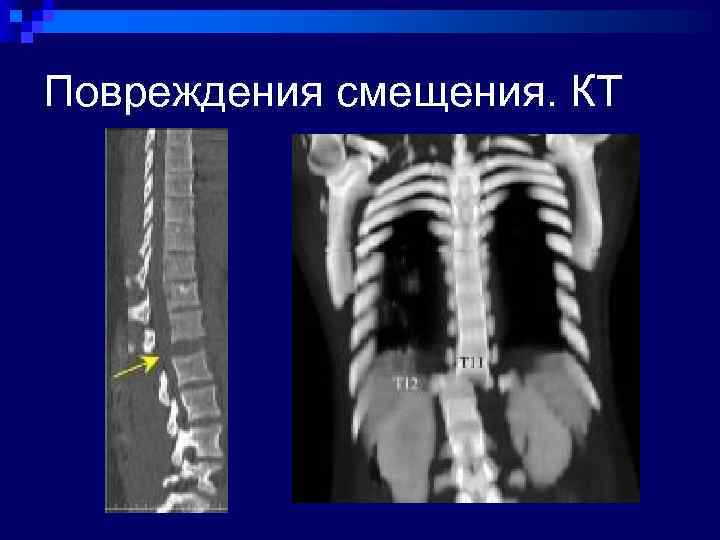 Компьютерная оптическая топография позвоночника что это