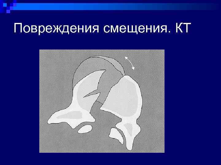 Повреждения смещения. КТ 