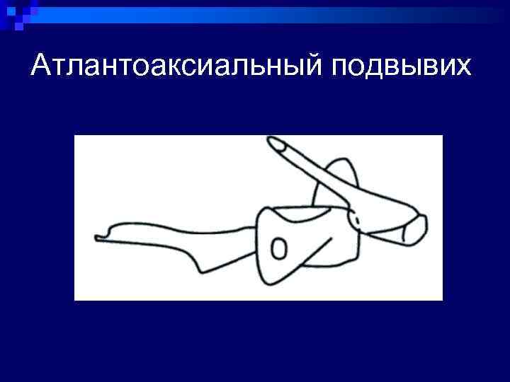 Атлантоаксиальный подвывих 