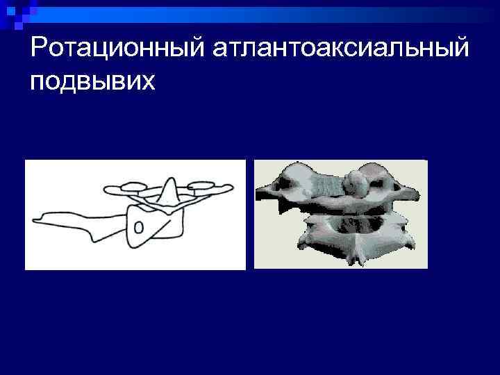 Ротационный атлантоаксиальный подвывих 
