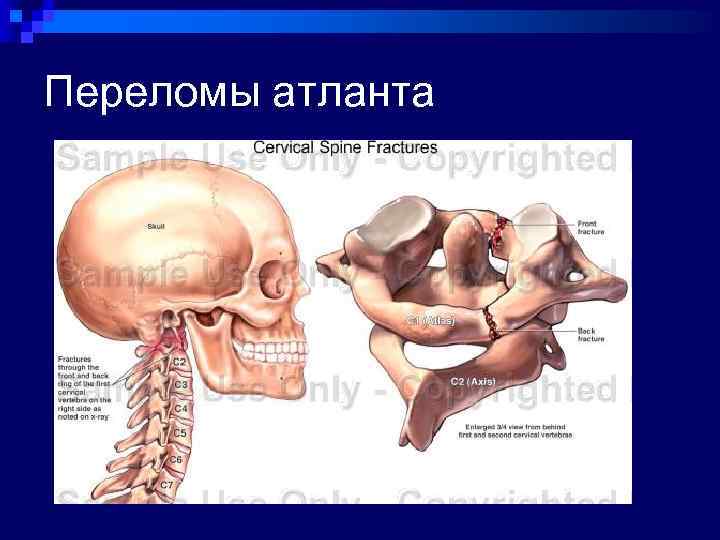 Переломы атланта 