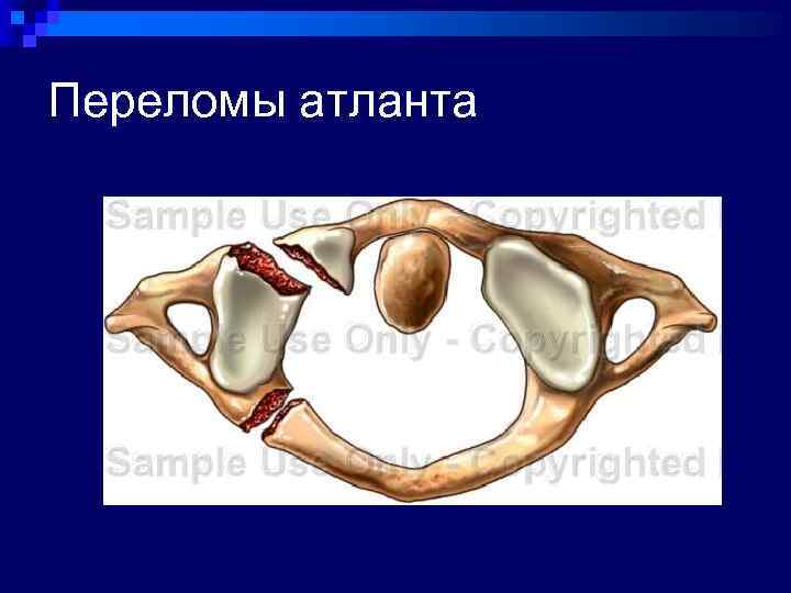 Переломы атланта 