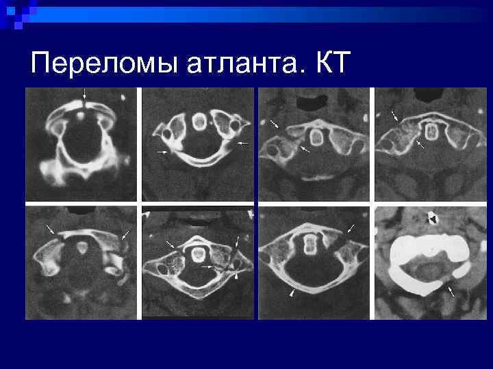 Кт картина ротационного подвывиха атланта