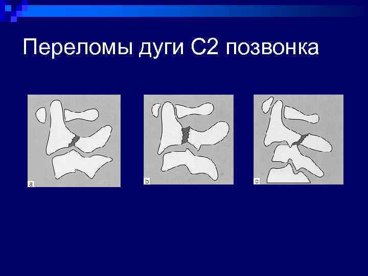 Перелом позвонка карта вызова