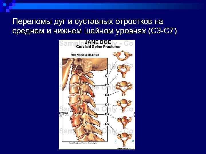 Переломы дуг и суставных отростков на среднем и нижнем шейном уровнях (С 3 -С