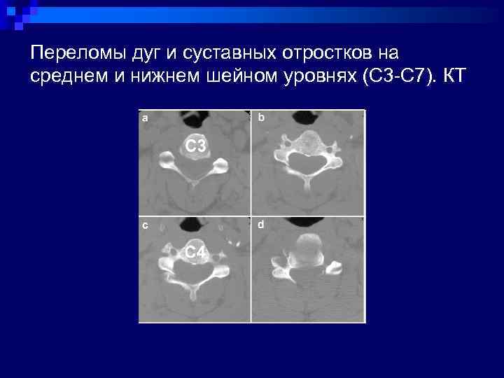 Переломы дуг и суставных отростков на среднем и нижнем шейном уровнях (С 3 -С
