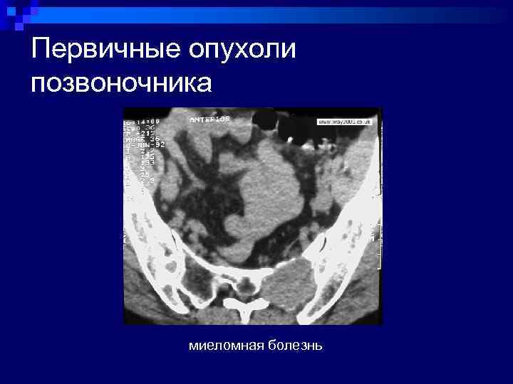 Первичные опухоли позвоночника миеломная болезнь 