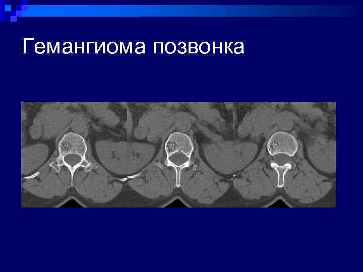 Гемангиома позвонка 