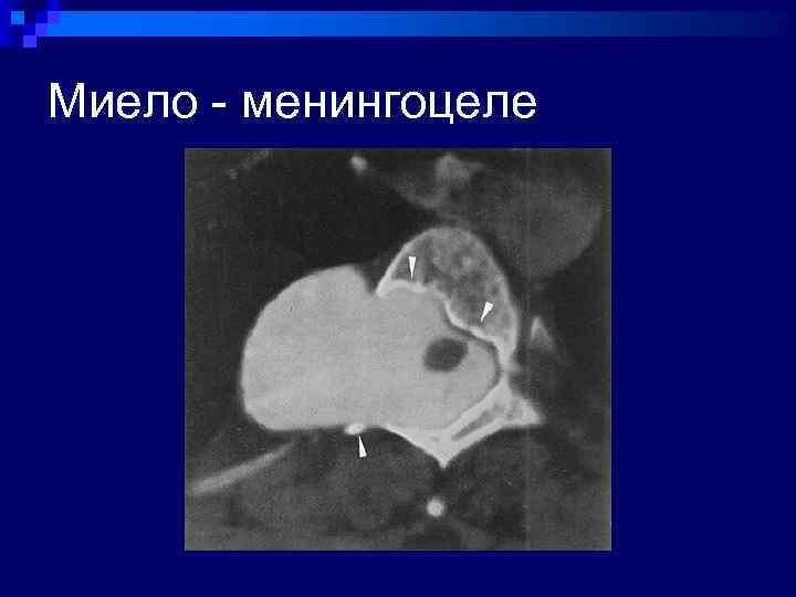 Миело - менингоцеле 