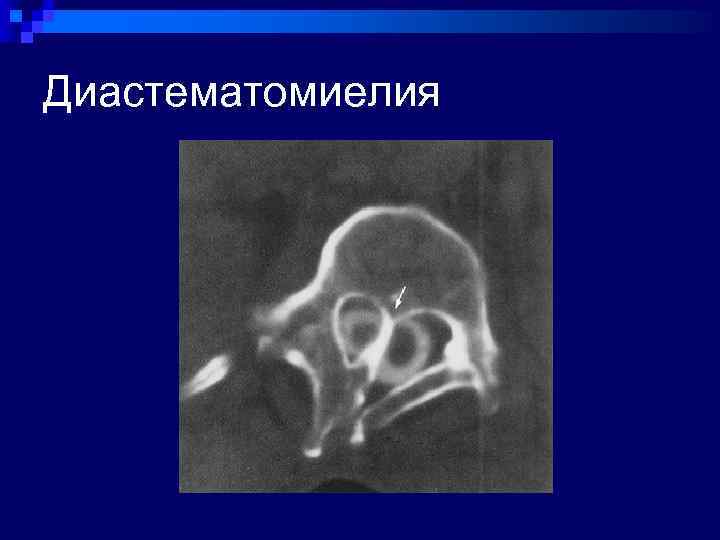 Диастематомиелия 