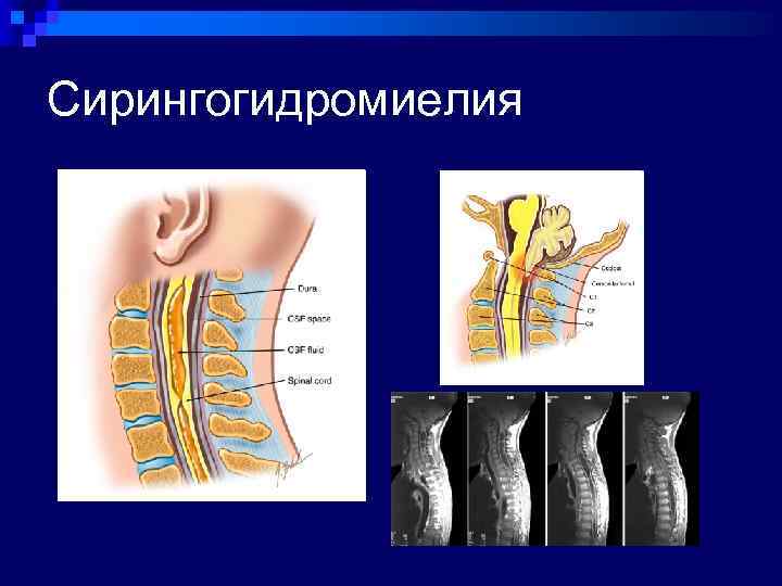 Сирингогидромиелия 