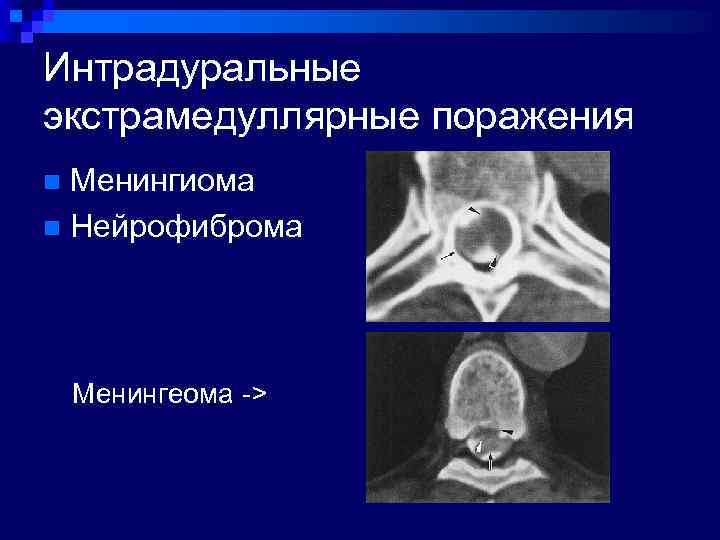 Интрадуральные экстрамедуллярные поражения Менингиома n Нейрофиброма n Менингеома -> 