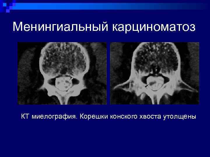 Менингиальный карциноматоз КТ миелография. Корешки конского хвоста утолщены 