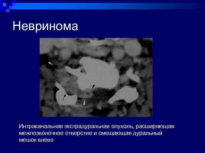 Невринома Интраканальная экстрадуральная опухоль, расширяющая межпозвоночное отверстие и смещающая дуральный мешок влево 