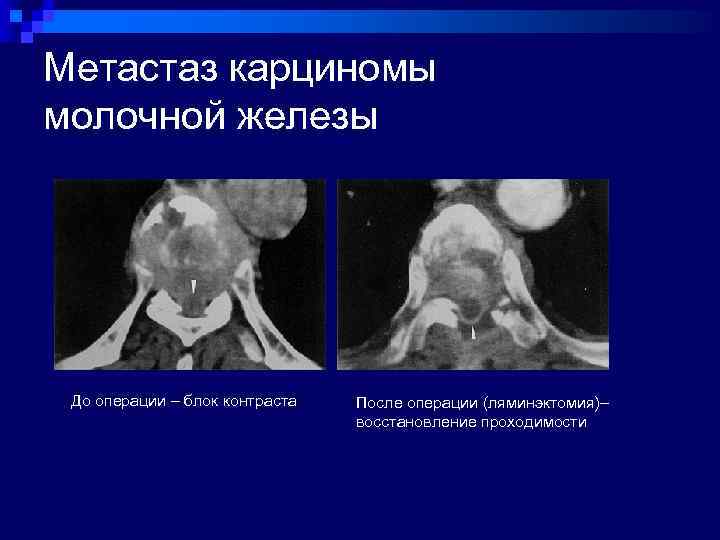Метастаз карциномы молочной железы До операции – блок контраста После операции (ляминэктомия)– восстановление проходимости