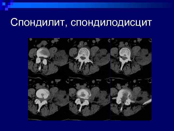 Спондилодисцит кт картина