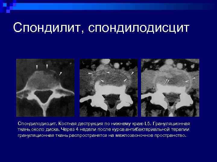 Кт картина краевой деструкции смежных костей наиболее характерна для