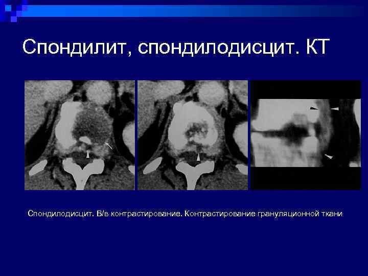 Спондилит, спондилодисцит. КТ Спондилодисцит. В/в контрастирование. Контрастирование грануляционной ткани 