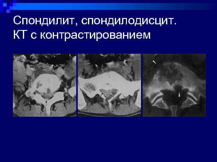 Спондилодисцит. Спондилодисцит на кт. Спондилит кт. Спондилит спондилодисцит. Кт картина спондилодисцита.