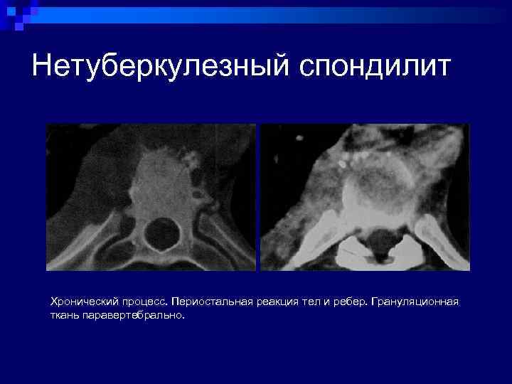 Компьютерная томография позвоночника как проводится видео