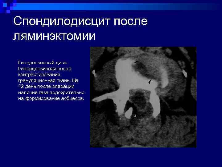 Спондилодисцит кт картина