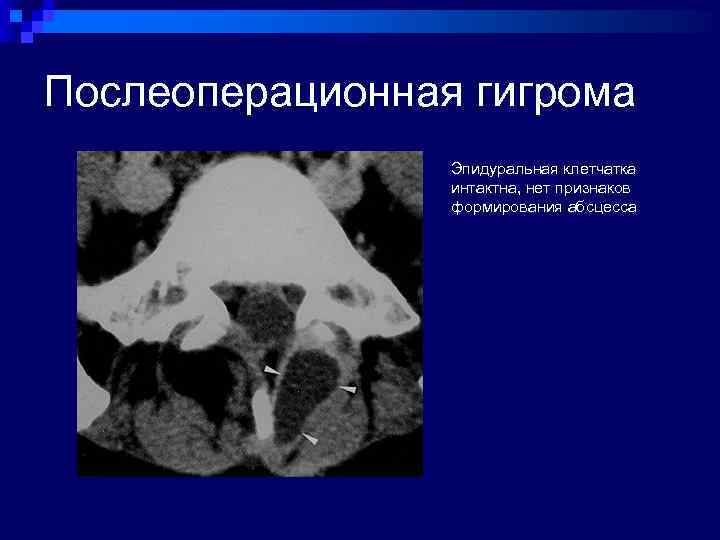 Послеоперационная гигрома Эпидуральная клетчатка интактна, нет признаков формирования абсцесса 