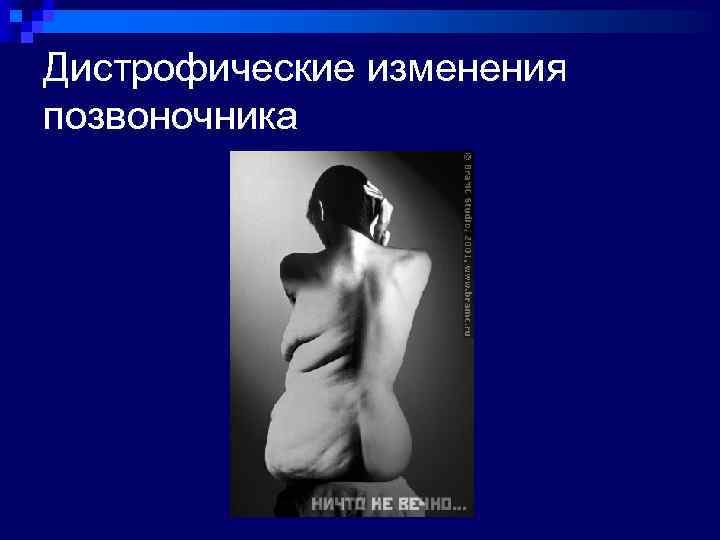 Дистрофические изменения позвоночника 