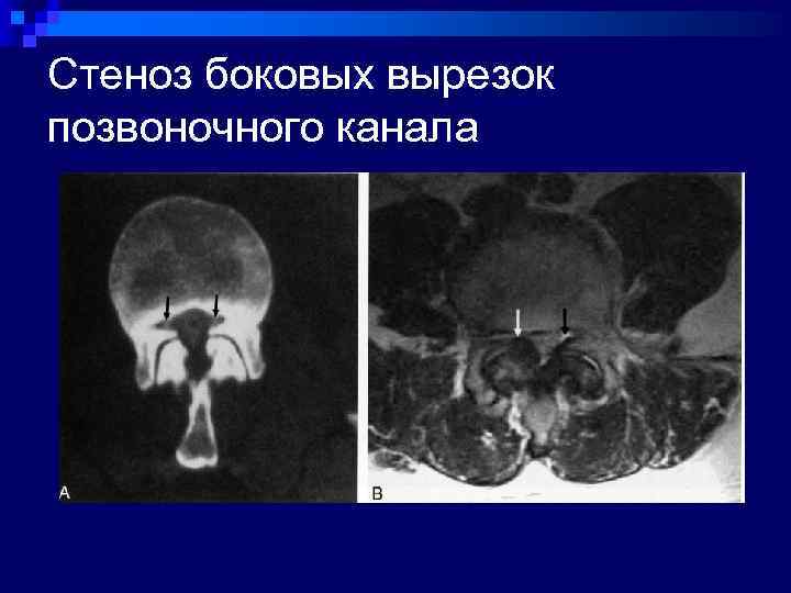 Стеноз боковых вырезок позвоночного канала 