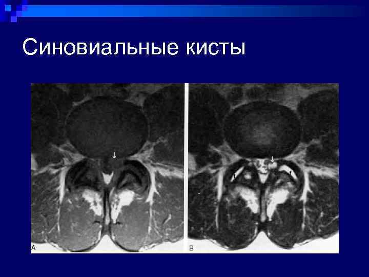 Синовиальные кисты 