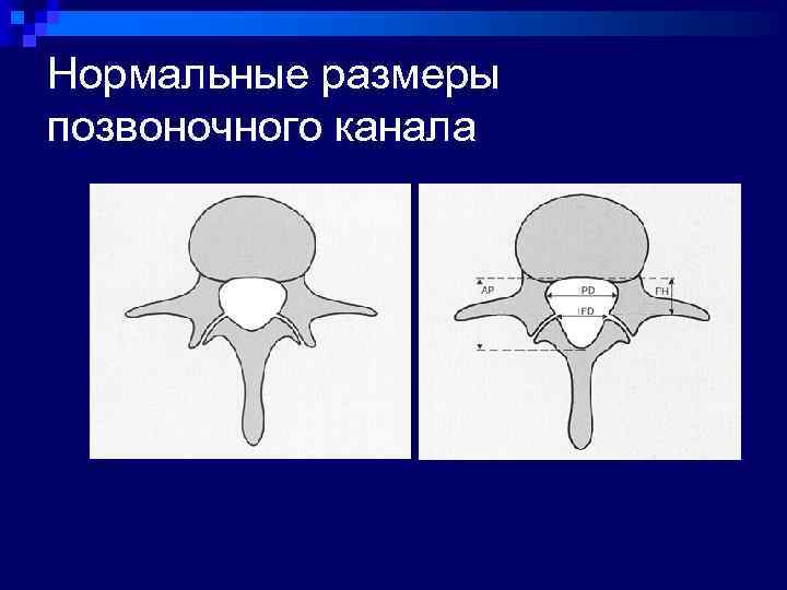 Нормальные размеры позвоночного канала 