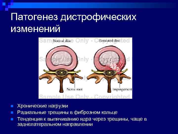 Мр картина дистрофических изменений