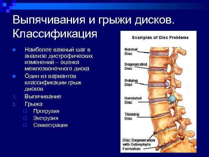 Мр картина дистрофических изменений пояснично крестцового отдела позвоночника дорзальных экструзий