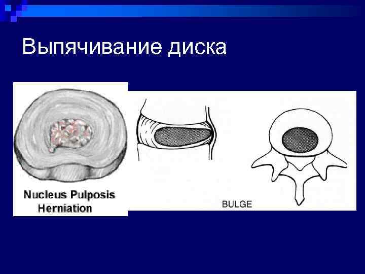 Выпячивание диска 