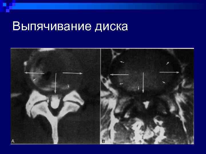 Выпячивание диска 