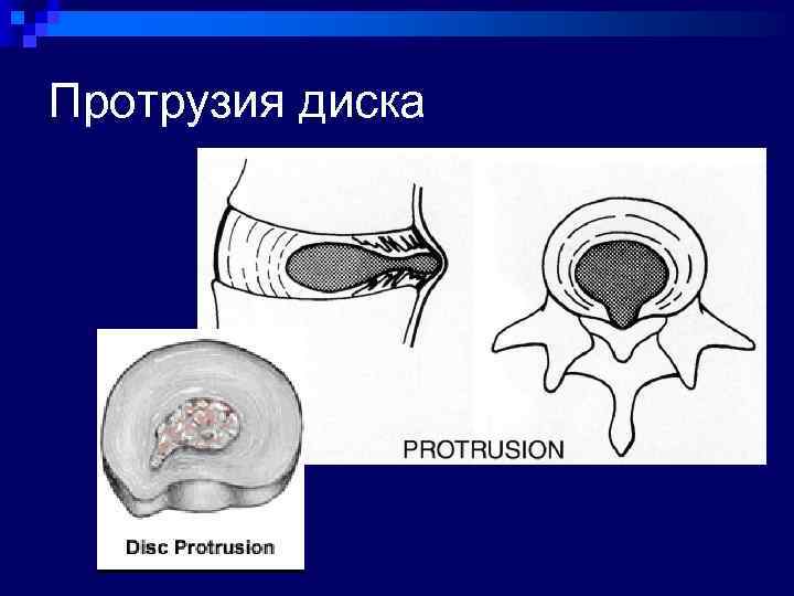 Компьютерная оптическая топография позвоночника что это