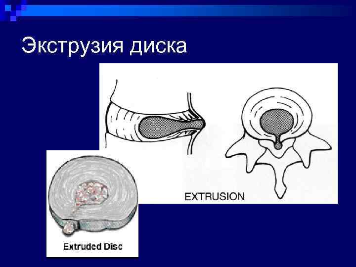 Экструзия м п